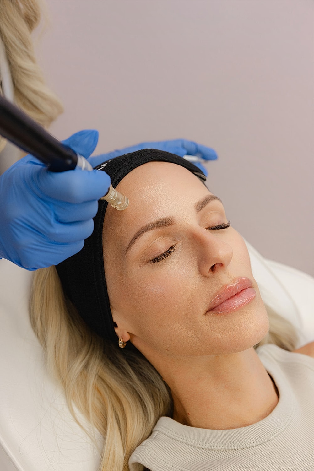 Microneedling treatment on a woman's face.
